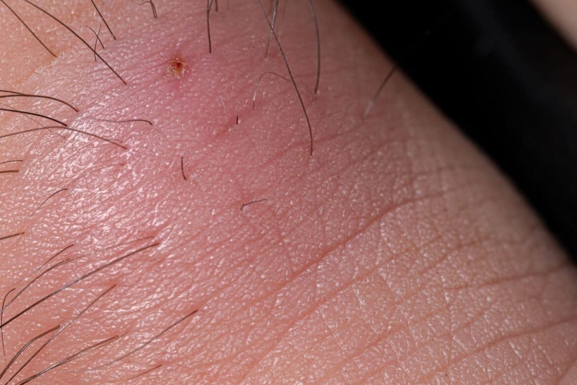 Essential Oils for Ingrown Hair