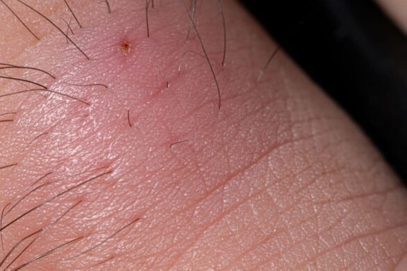 Essential Oils for Ingrown Hair