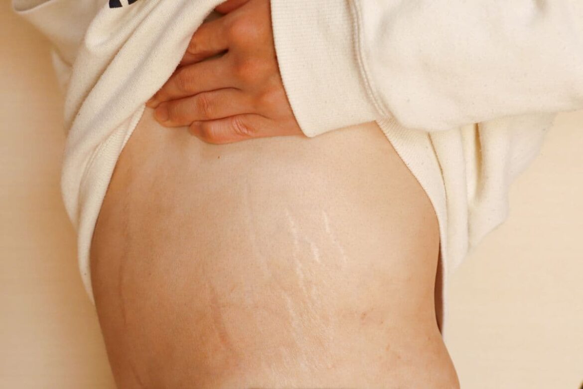 Essential Oils for Stretch Marks Essential Oils for Stretch Marks