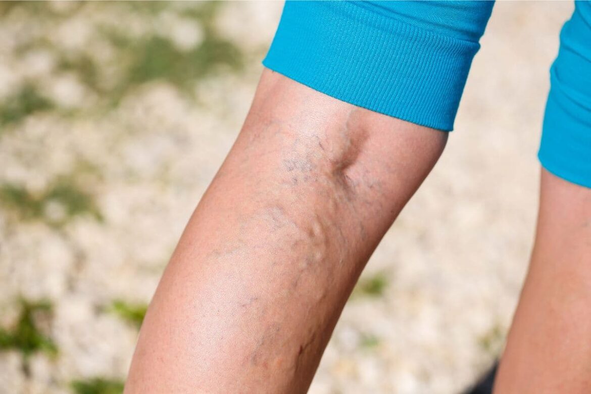 Essential Oils for Varicose Veins