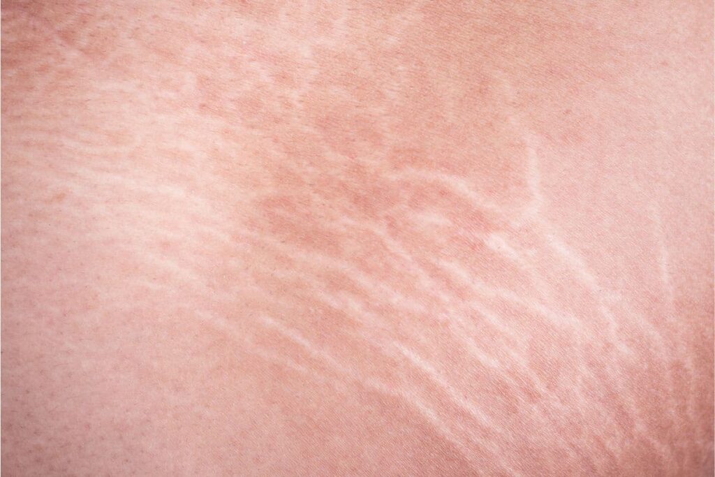 Stretch Marks Close Up