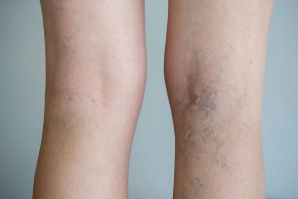 Varicose Veins on Leg